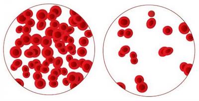 Non-invasive detection of anemia using lip mucosa images transfer learning convolutional neural networks